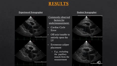 most accurate ejection fraction measurement.